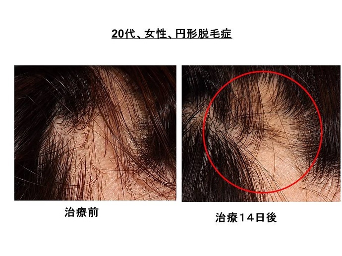 円形脱毛症　病院""